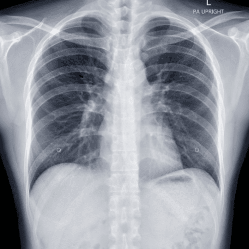 X-Ray