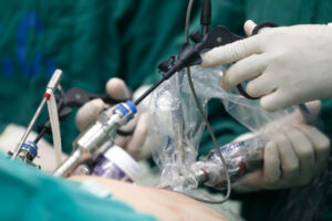 Read more about the article Laparoscopic Appendectomy: Procedure, Recovery, and What to Expect